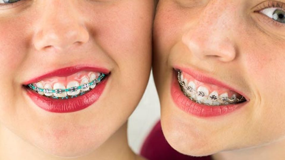 Braces (Orthodontia) (featured image)