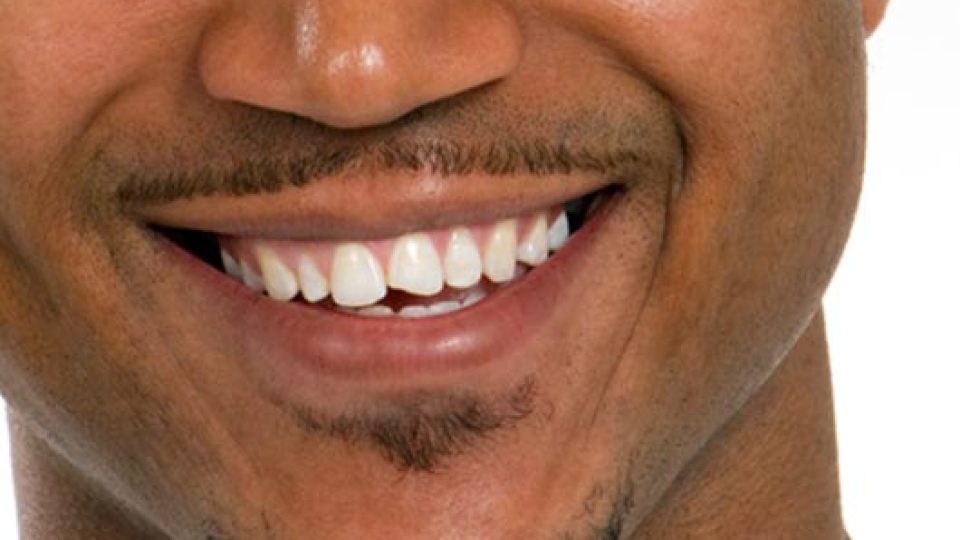 Chipped, Cracked, and Worn Teeth (featured image)