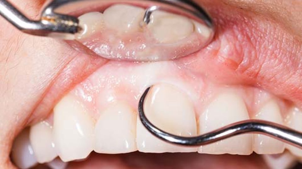 Flap Surgery (featured image)