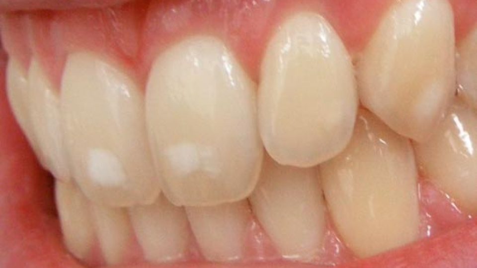 Fluorosis (featured image)