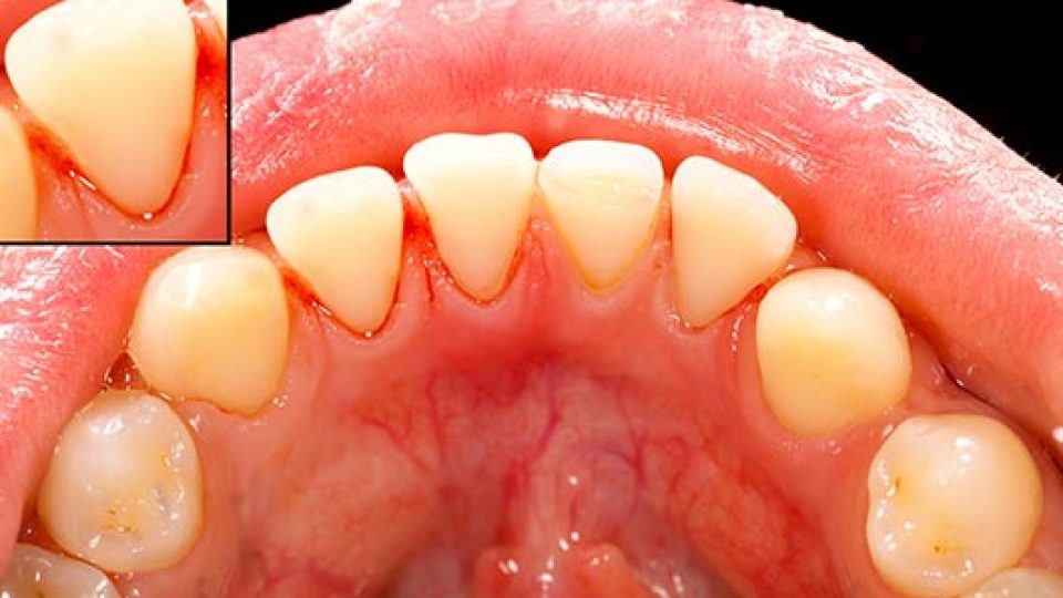 Gum Disease (Gingivitis) (featured image)