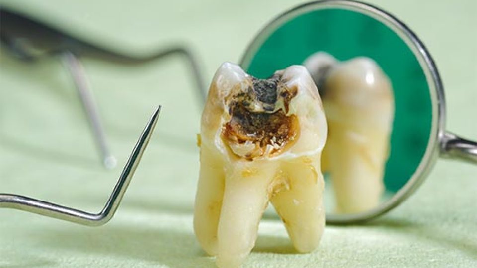 What is Tooth Decay? (featured image)