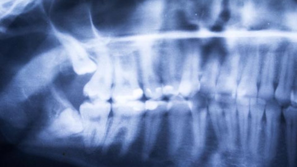 Wisdom Teeth (featured image)